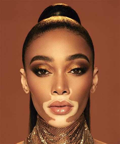 vitiligo nude|Winnie Harlow Poses Nude to Show Beauty of Her Vitiligo